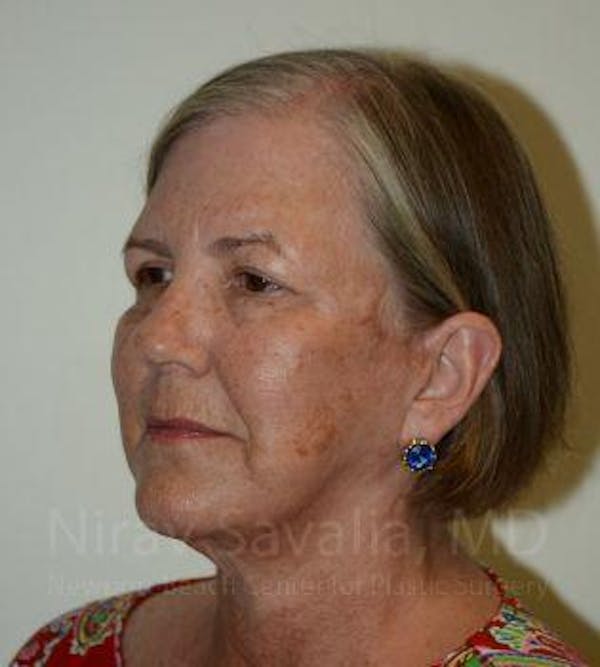 Facelift Before & After Gallery - Patient 1655699 - Image 6