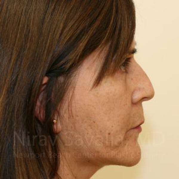 Brow Lift Before & After Gallery - Patient 1655702 - Image 4