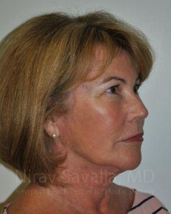 Fat Grafting to Face Before & After Gallery - Patient 1655698 - Image 6