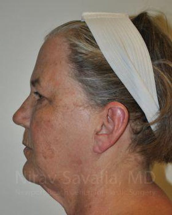 Facelift Before & After Gallery - Patient 1655699 - Image 7