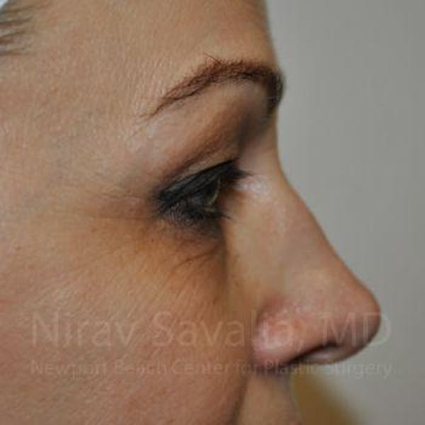 Eyelid Surgery Before & After Gallery - Patient 1655701 - Image 5
