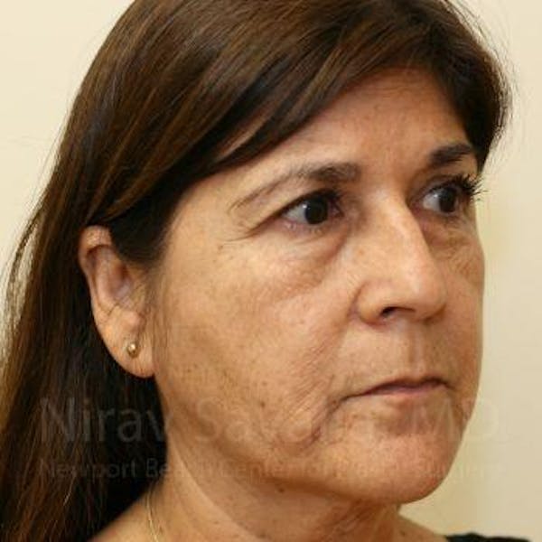Brow Lift Before & After Gallery - Patient 1655702 - Image 5