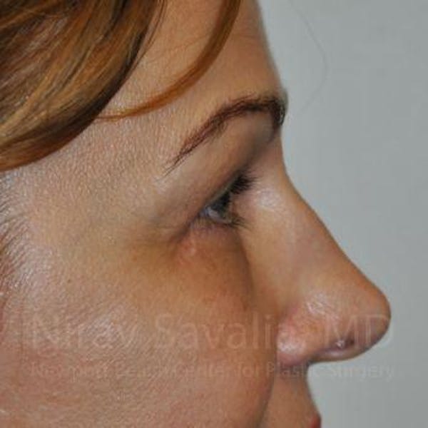 Eyelid Surgery Gallery - Patient 1655701 - Image 6
