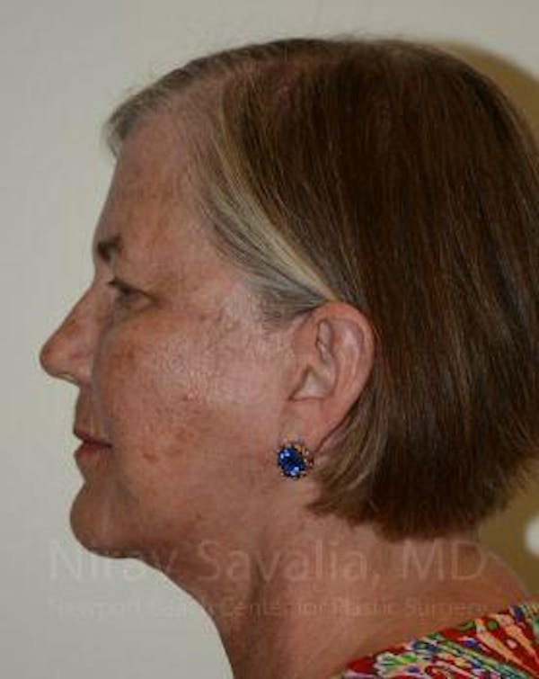 Facelift Before & After Gallery - Patient 1655699 - Image 8