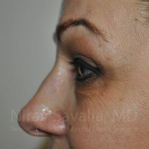 Eyelid Surgery Before & After Gallery - Patient 1655701 - Image 7