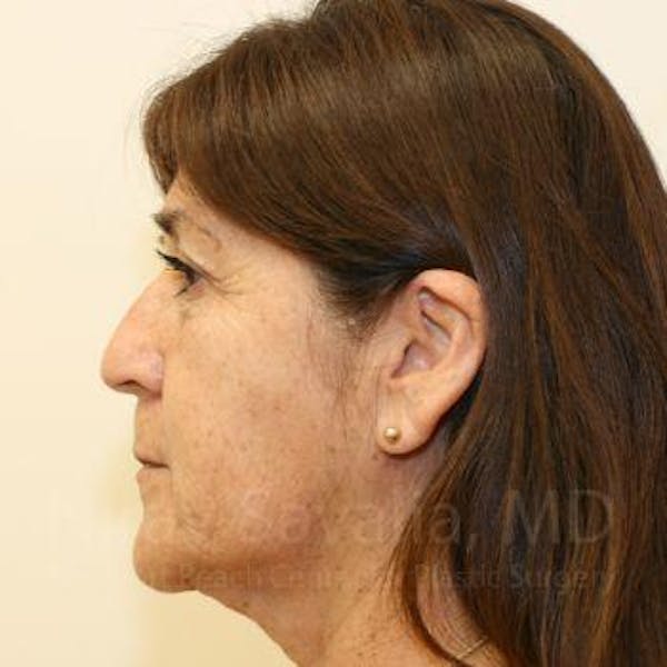 Brow Lift Before & After Gallery - Patient 1655702 - Image 7