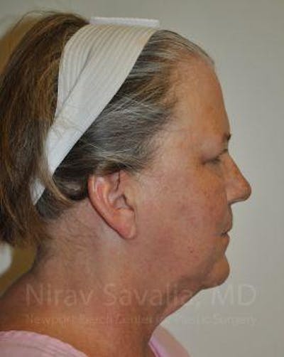 Facelift Before & After Gallery - Patient 1655699 - Image 1