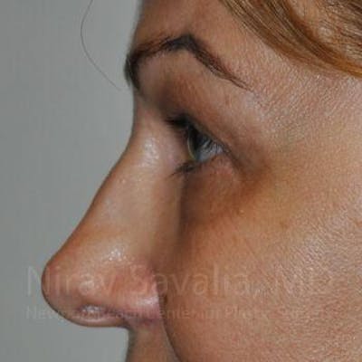 Eyelid Surgery Before & After Gallery - Patient 1655701 - Image 8