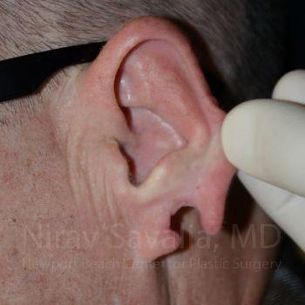Torn Earlobe Repair / Ear Gauge Repair Gallery - Patient 1655700 - Image 1