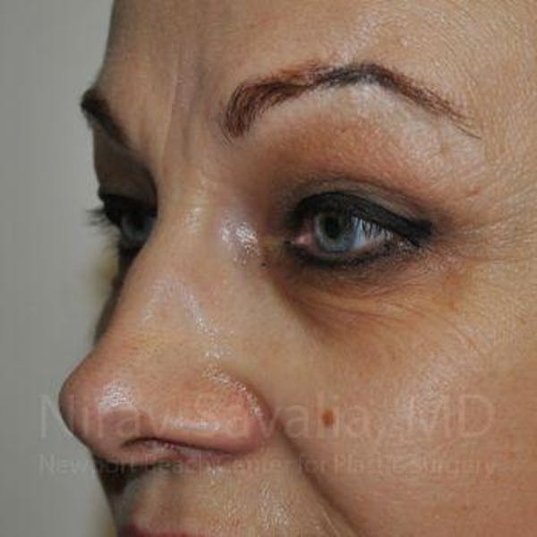 Eyelid Surgery Before & After Gallery - Patient 1655701 - Image 9