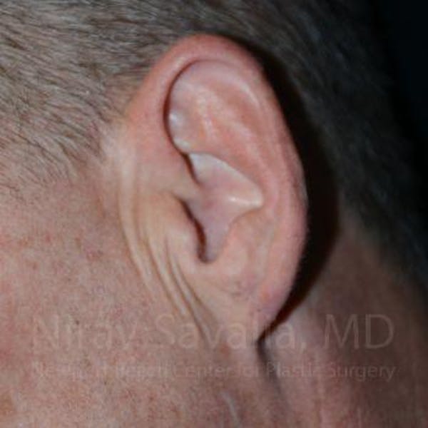 Torn Earlobe Repair / Ear Gauge Repair Before & After Gallery - Patient 1655700 - Image 2