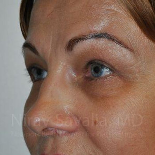 Eyelid Surgery Before & After Gallery - Patient 1655701 - Image 10