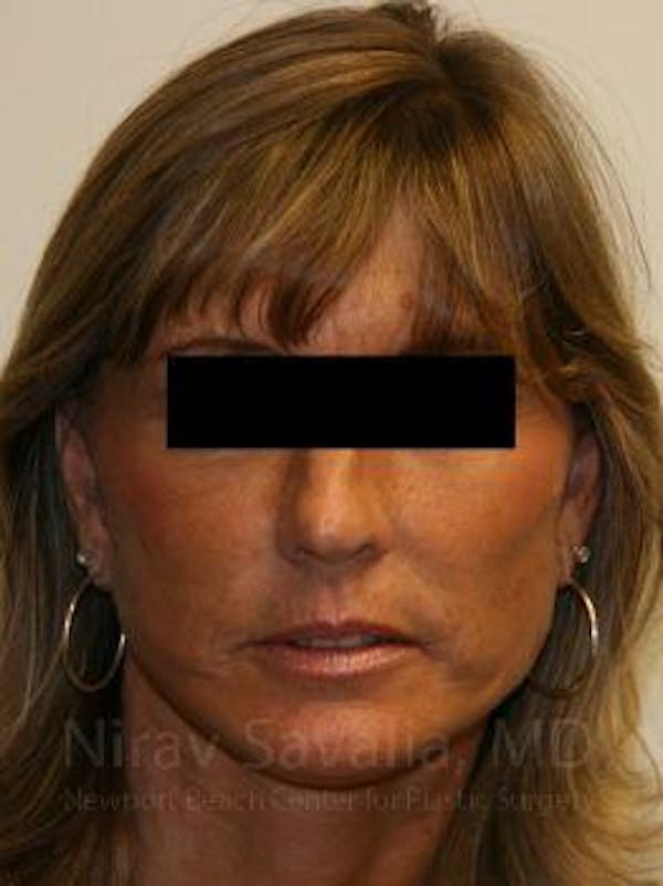 Facelift Before & After Gallery - Patient 1655704 - Image 6