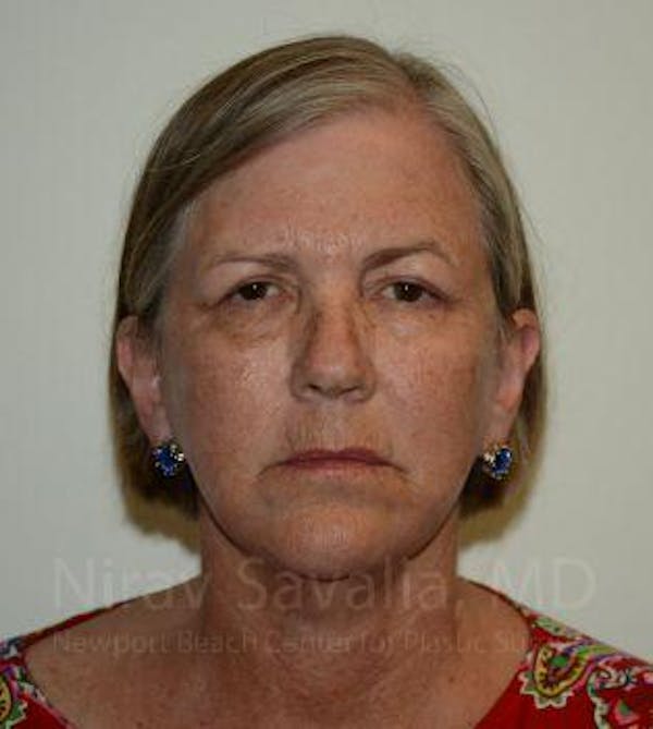 Fat Grafting to Face Before & After Gallery - Patient 1655705 - Image 2