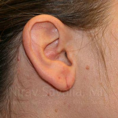 Torn Earlobe Repair / Ear Gauge Repair Before & After Gallery - Patient 1655703 - Image 1