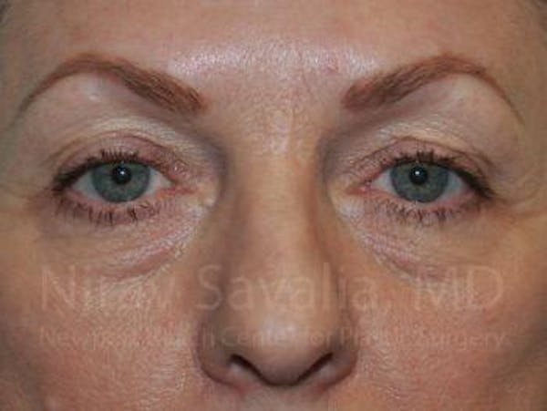 Eyelid Surgery Before & After Gallery - Patient 1655707 - Image 1