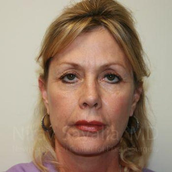 Brow Lift Before & After Gallery - Patient 1655706 - Image 1