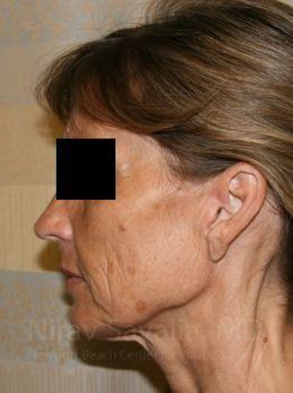 Facelift Before & After Gallery - Patient 1655704 - Image 3