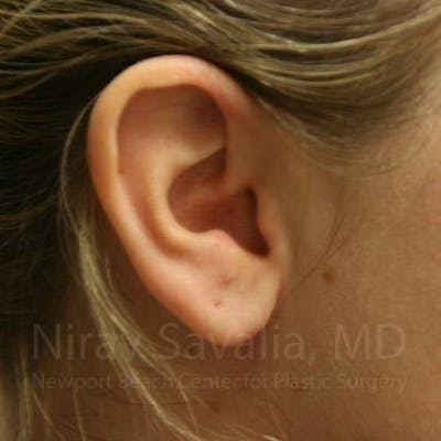 Torn Earlobe Repair / Ear Gauge Repair Before & After Gallery - Patient 1655703 - Image 2