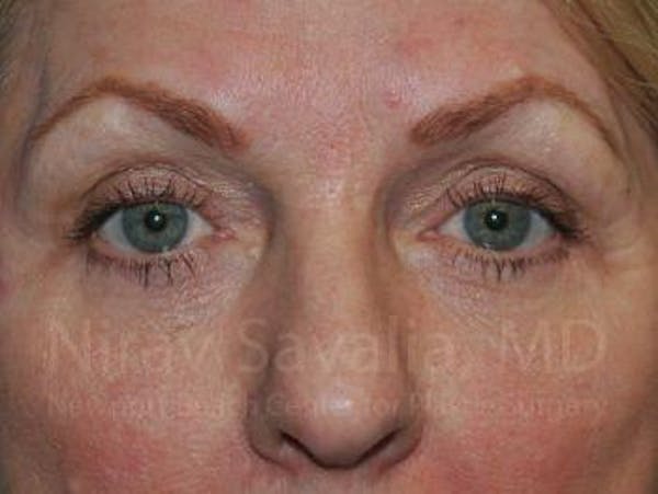 Eyelid Surgery Before & After Gallery - Patient 1655707 - Image 2