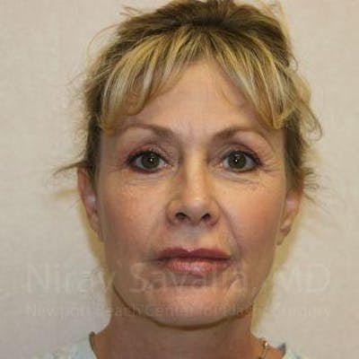 Brow Lift Before & After Gallery - Patient 1655706 - Image 2
