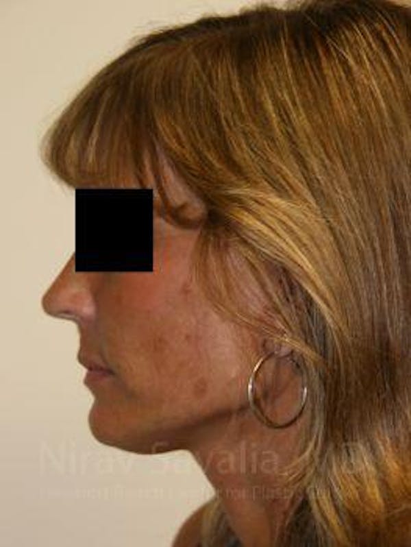 Facelift Before & After Gallery - Patient 1655704 - Image 4