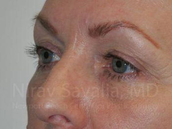 Eyelid Surgery Before & After Gallery - Patient 1655707 - Image 3
