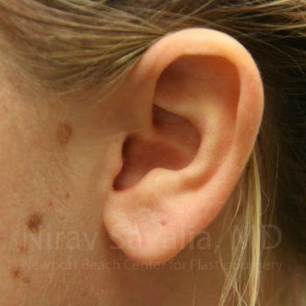 Torn Earlobe Repair / Ear Gauge Repair Gallery - Patient 1655703 - Image 4