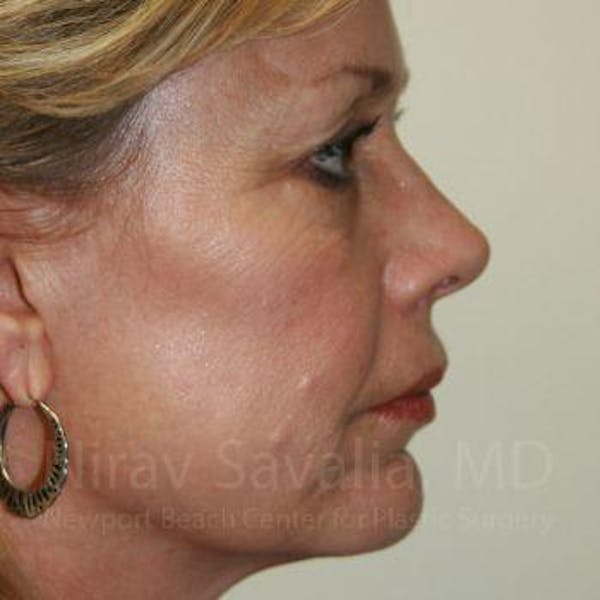 Brow Lift Before & After Gallery - Patient 1655706 - Image 3