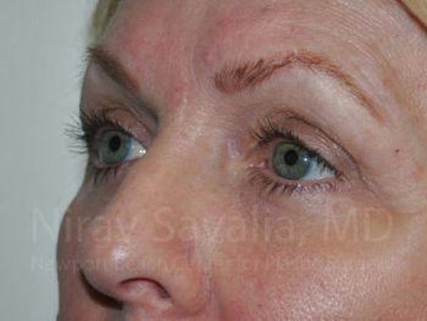 Eyelid Surgery Before & After Gallery - Patient 1655707 - Image 4