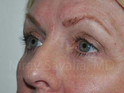Eyelid Surgery Gallery - Patient 1655707 - Image 4
