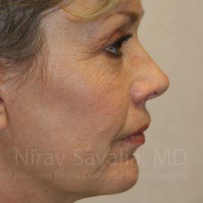 Brow Lift Before & After Gallery - Patient 1655706 - Image 4