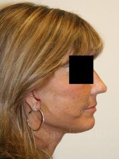 Facelift Before & After Gallery - Patient 1655704 - Image 2