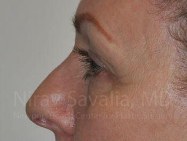 Eyelid Surgery Before & After Gallery - Patient 1655707 - Image 5