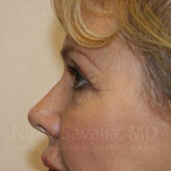 Brow Lift Before & After Gallery - Patient 1655706 - Image 5
