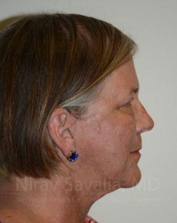 Fat Grafting to Face Before & After Gallery - Patient 1655705 - Image 8
