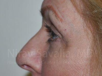 Eyelid Surgery Before & After Gallery - Patient 1655707 - Image 6