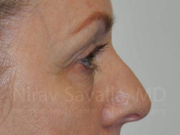 Eyelid Surgery Before & After Gallery - Patient 1655707 - Image 7