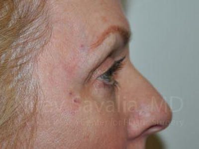 Eyelid Surgery Before & After Gallery - Patient 1655707 - Image 8