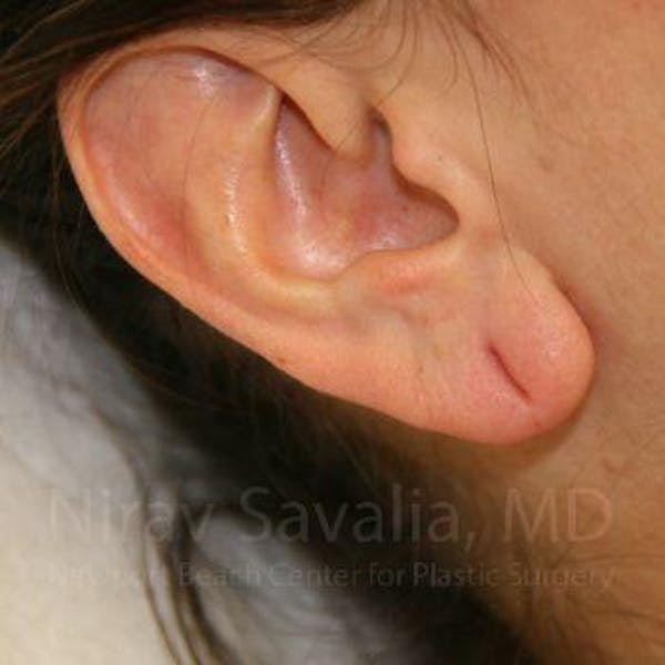 Torn Earlobe Repair / Ear Gauge Repair Gallery - Patient 1655708 - Image 1
