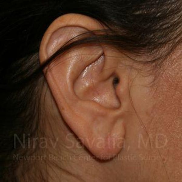 Torn Earlobe Repair / Ear Gauge Repair Before & After Gallery - Patient 1655708 - Image 2