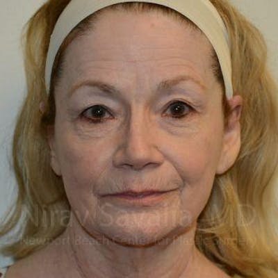 Fat Grafting to Face Before & After Gallery - Patient 1655710 - Image 1
