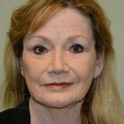 Fat Grafting to Face Before & After Gallery - Patient 1655710 - Image 2