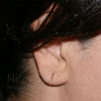 Torn Earlobe Repair / Ear Gauge Repair Before & After Gallery - Patient 1655709 - Image 1