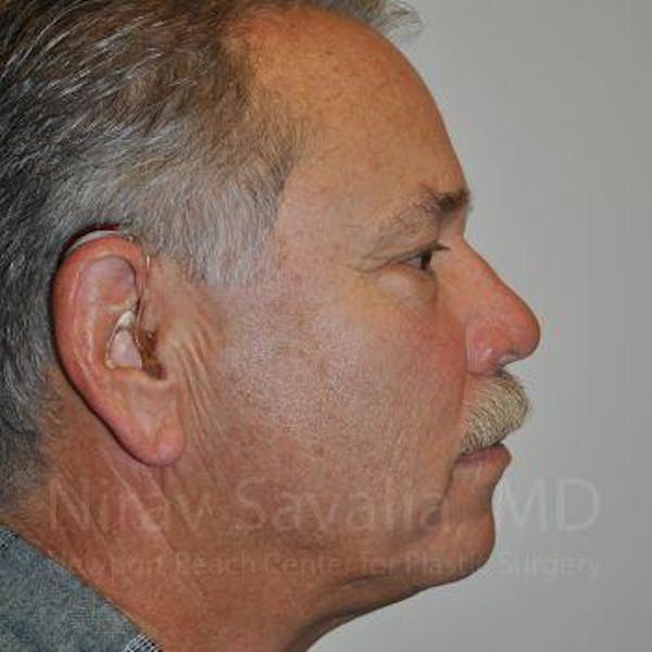 Eyelid Surgery Before & After Gallery - Patient 1655711 - Image 3