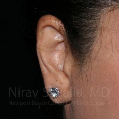 Torn Earlobe Repair / Ear Gauge Repair Before & After Gallery - Patient 1655709 - Image 2