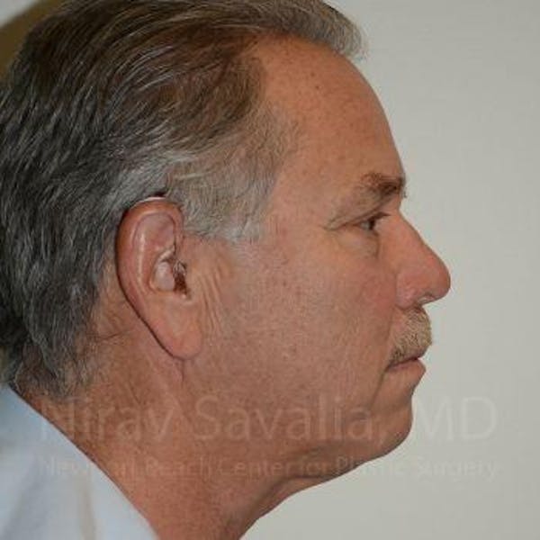 Eyelid Surgery Before & After Gallery - Patient 1655711 - Image 4
