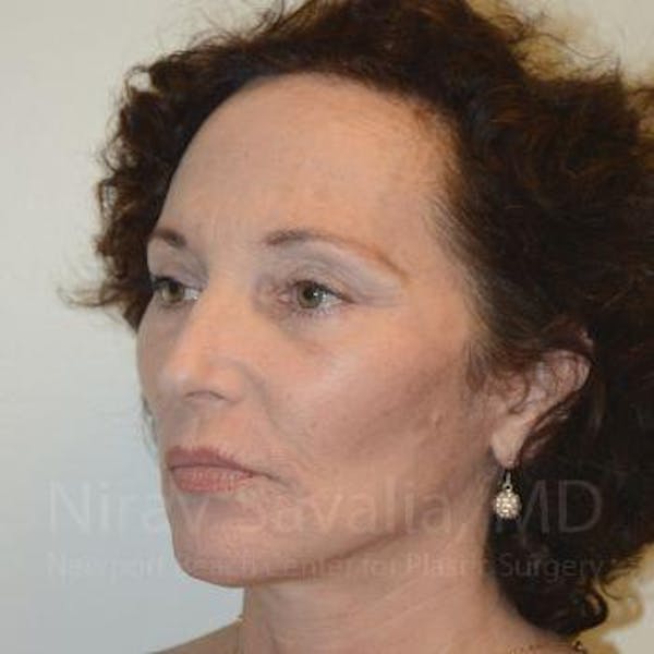 Facelift Before & After Gallery - Patient 1655712 - Image 8