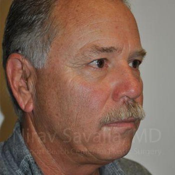 Eyelid Surgery Before & After Gallery - Patient 1655711 - Image 5