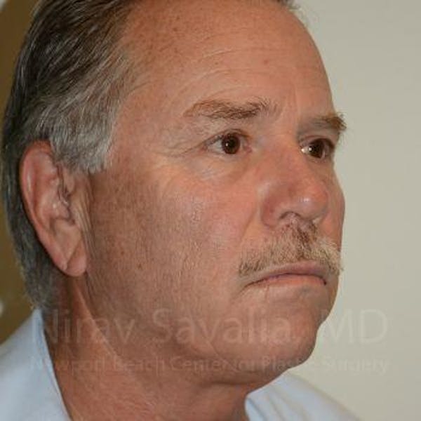 Eyelid Surgery Before & After Gallery - Patient 1655711 - Image 6